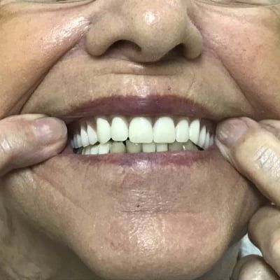 Dentures