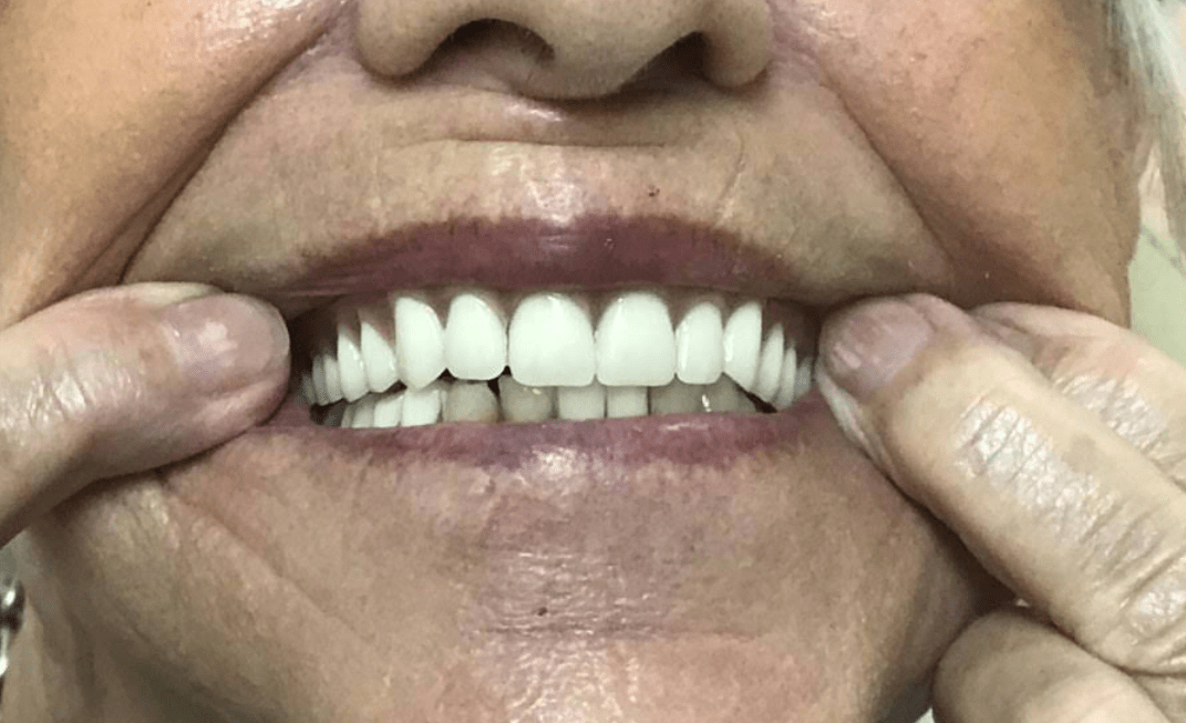 Emergency Denture Services gallery